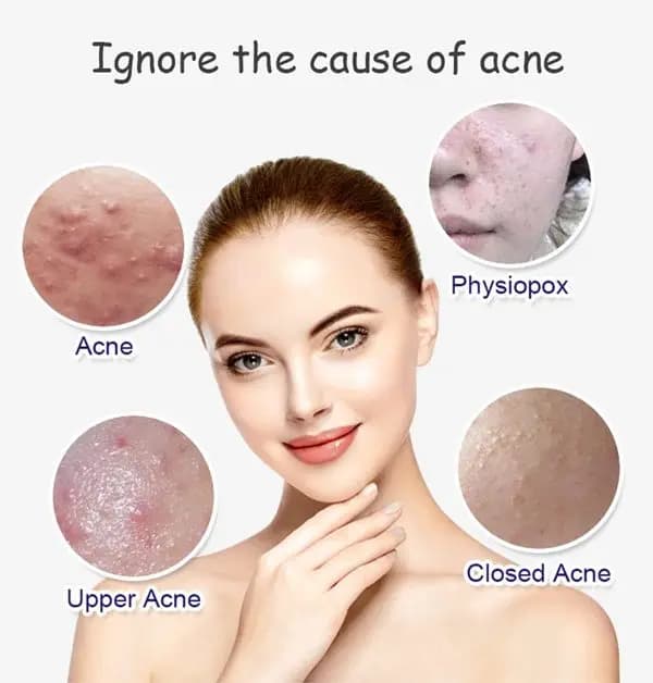 IMPORTED AICHUN BEAUTY Anti-Acne Facial Serum Aloe Vera Extract Salicylic Acid Repairs Damaged Skin 30ml