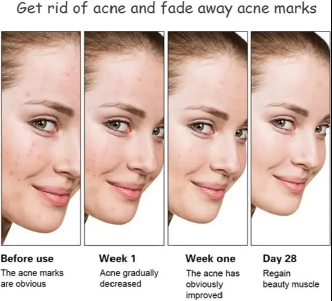 IMPORTED AICHUN BEAUTY Anti-Acne Facial Serum Aloe Vera Extract Salicylic Acid Repairs Damaged Skin 30ml